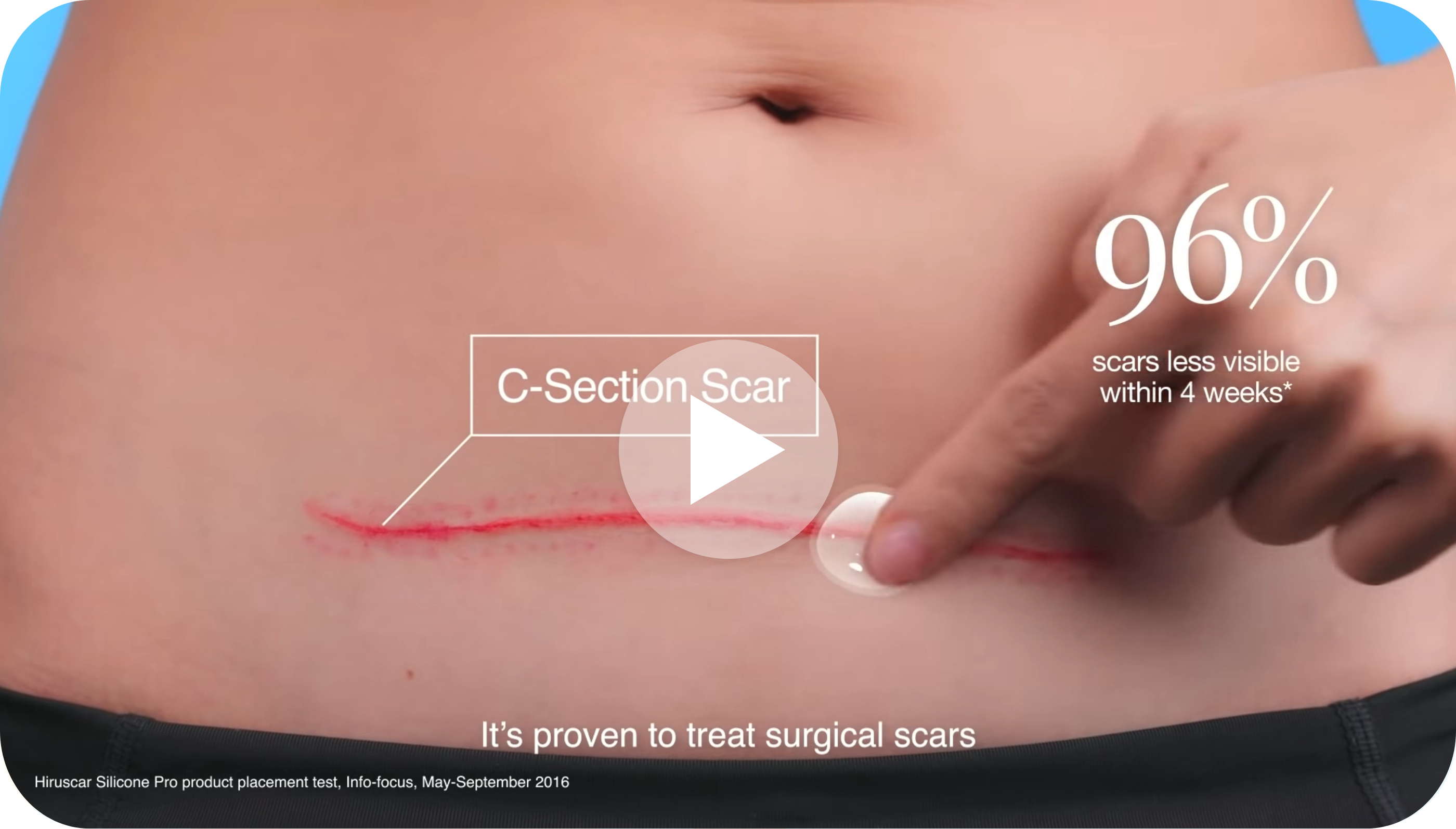 Hiruscar Silicone Pro - Clinically Proven to Treat Surgical Scars
